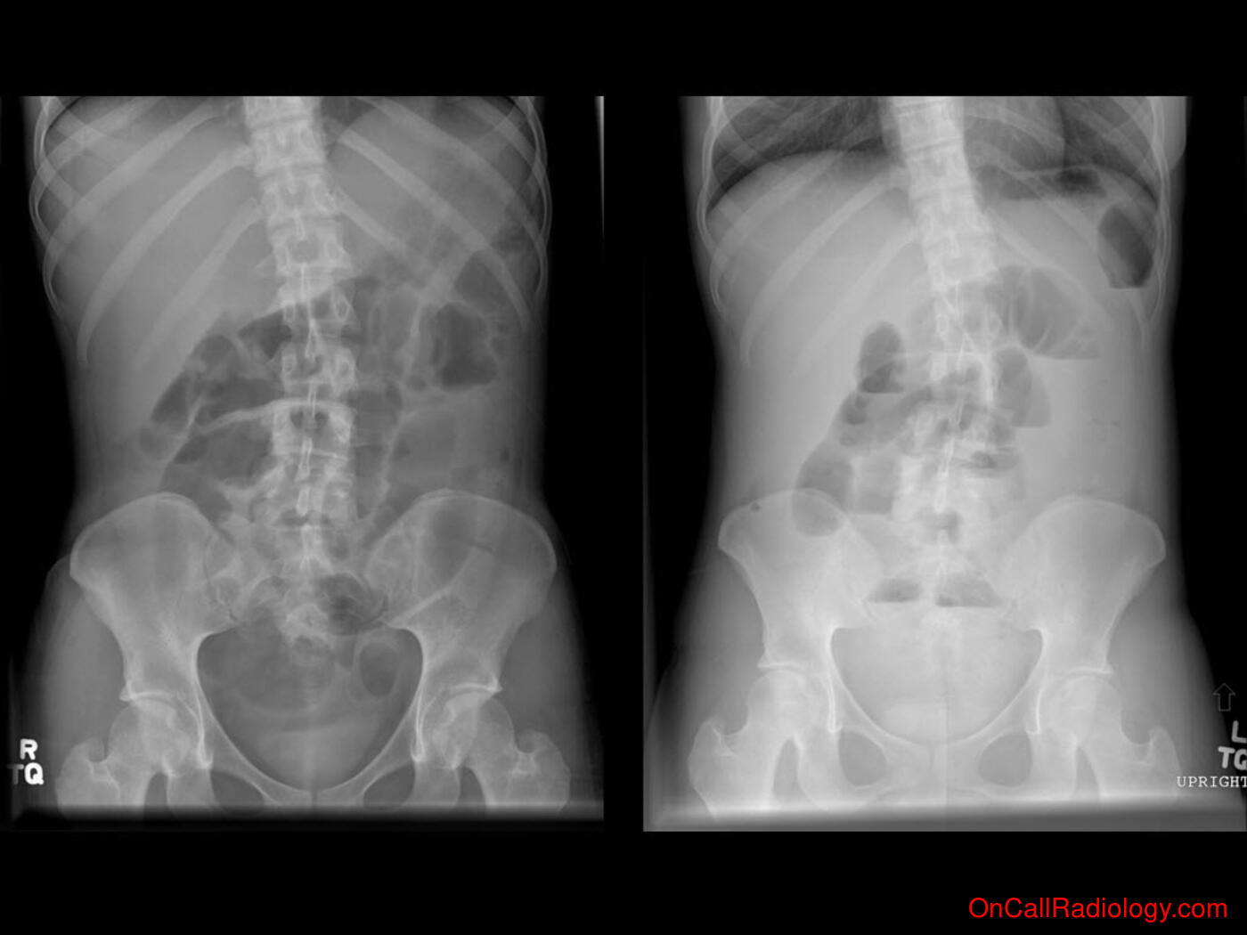 Obstruction (Crohns flare causing small bowel obstruction - Plain film, Radiograph, CT, Computed tomography)