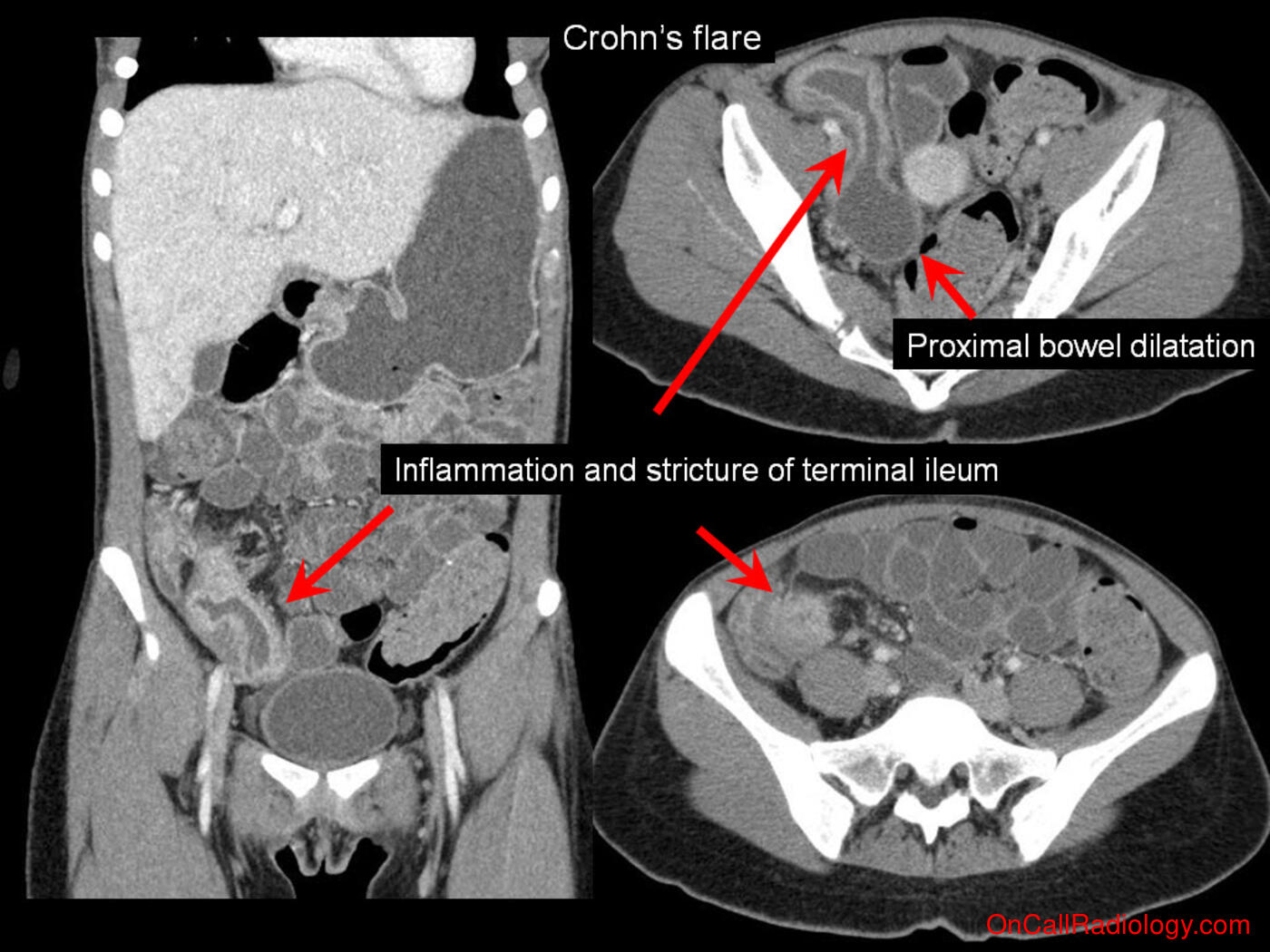 Obstruction (Crohns flare causing small bowel obstruction - Plain film, Radiograph, CT, Computed tomography)