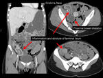 Crohns flare causing small bowel obstruction