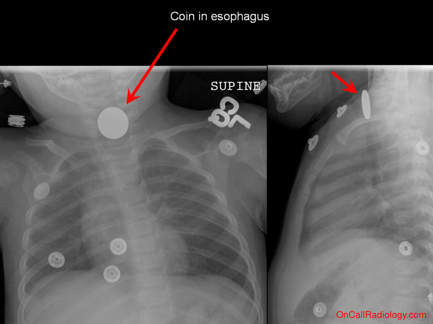 Foreign body (Coin in esophagus - Plain film, Radiograph)