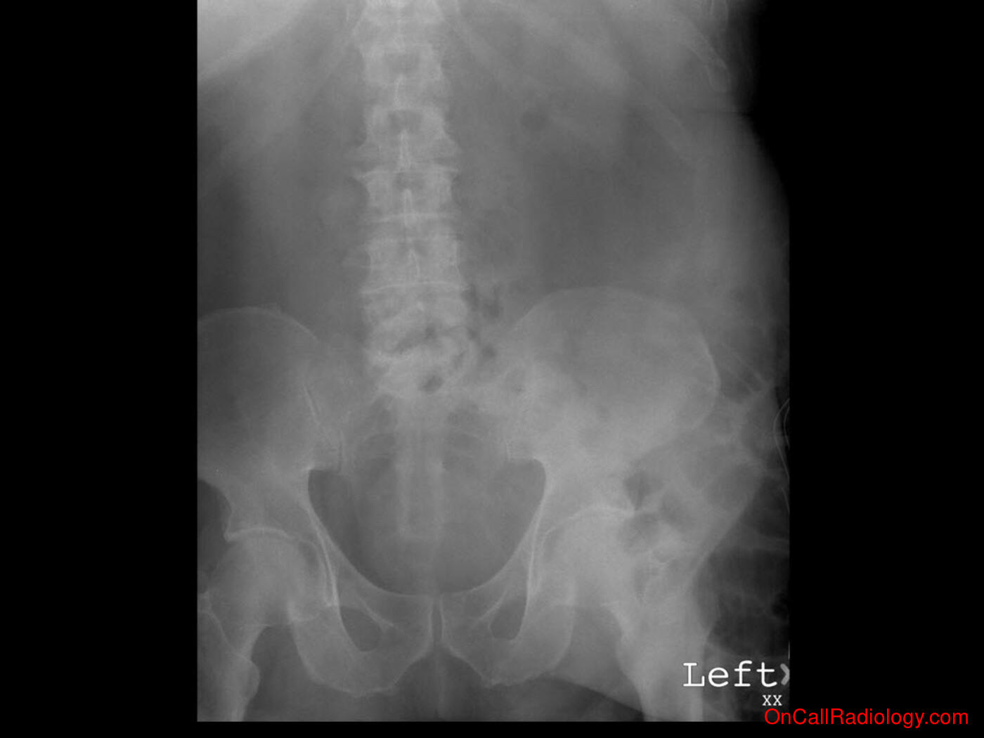 Obstruction (Obstructing abdominal hernia - Plain film, Radiograph)