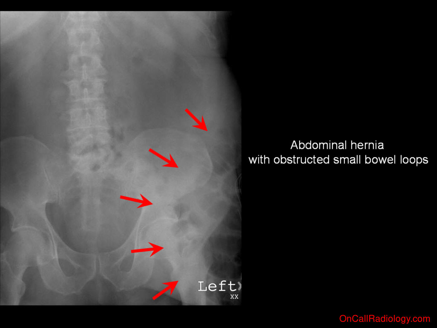 Obstruction (Obstructing abdominal hernia - Plain film, Radiograph)