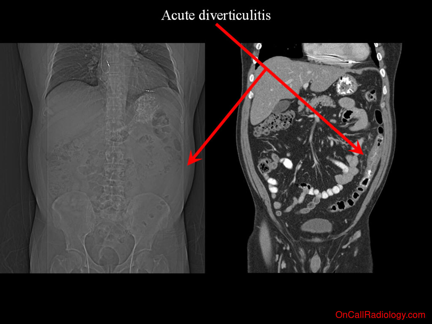 Inflammation (Acute diverticulitis - Plain film, Radiograph, CT, Computed tomography)