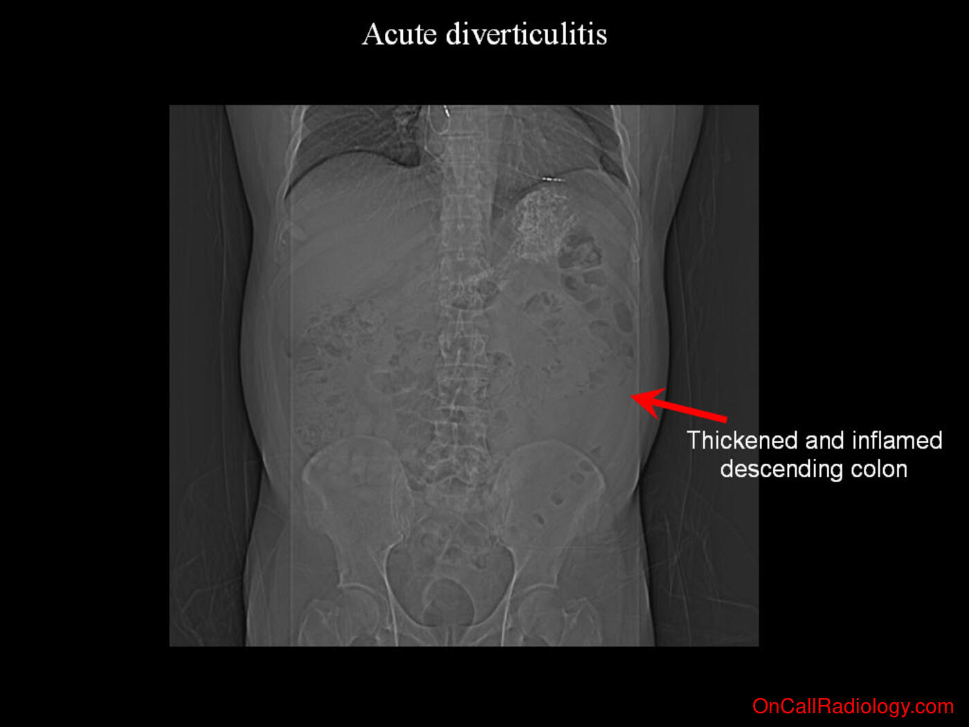 Inflammation (Acute diverticulitis - Plain film, Radiograph, CT, Computed tomography)