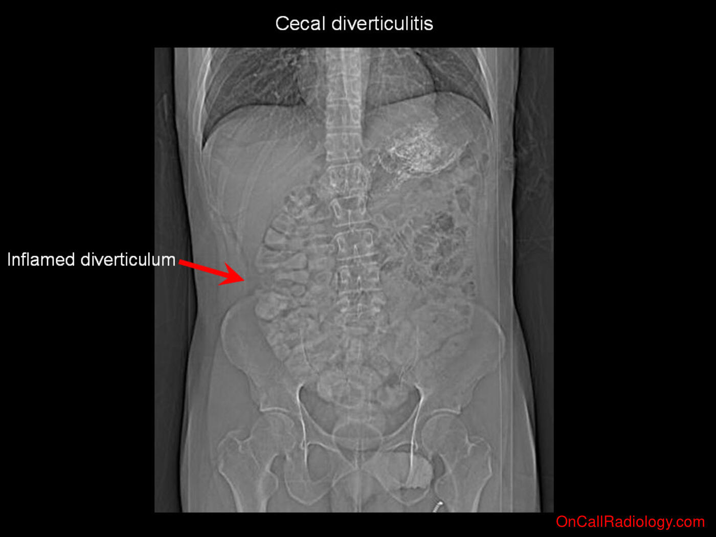 Inflammation (Cecal diverticulitis - Plain film, Radiograph, CT, Computed tomography)