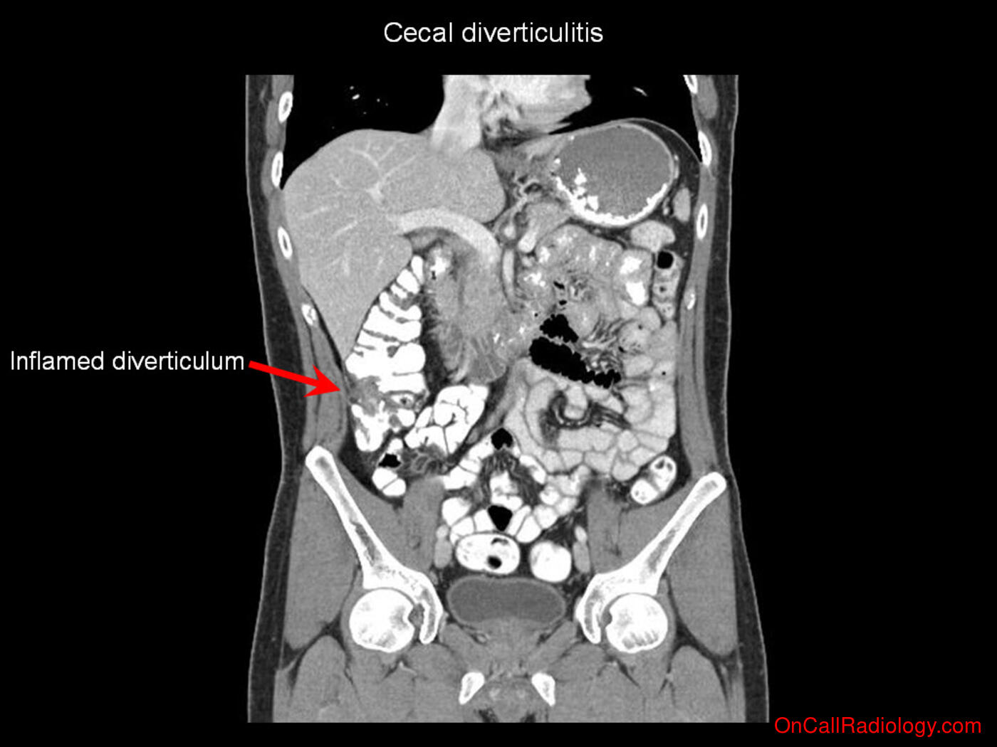 Inflammation (Cecal diverticulitis - Plain film, Radiograph, CT, Computed tomography)