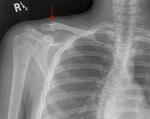 Clavicular Bayonette fracture