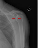 Posterior shoulder dislocation
