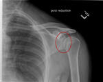 Posterior shoulder dislocation