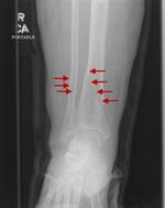 Distal tibial and fibular fracture