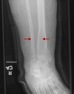Distal tibial and fibular fracture