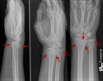 Distal radius and ulnar styloid fracture