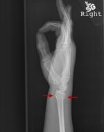 Distal radius and ulnar styloid fracture