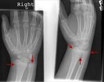 Distal radius and ulnar head fracture