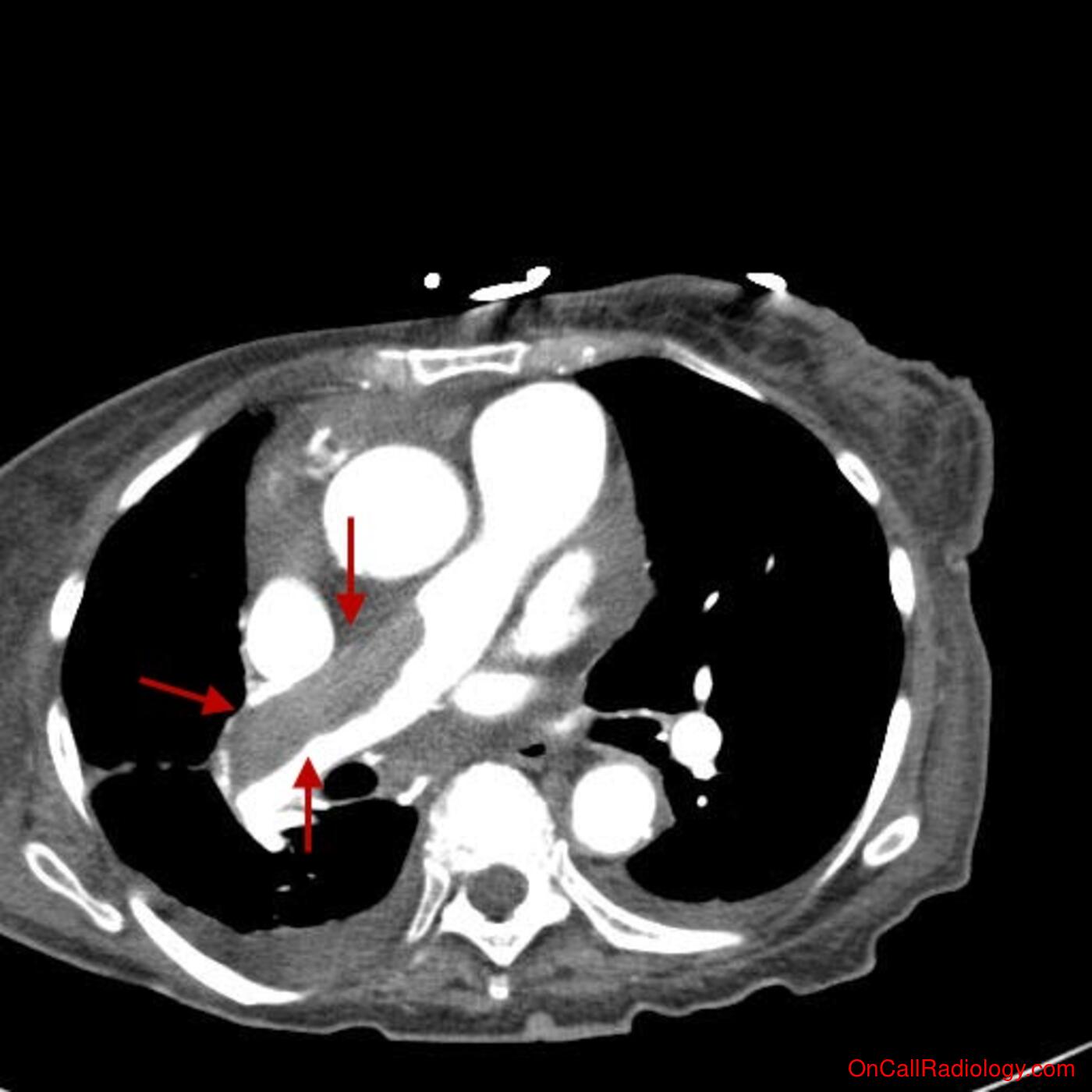 Thromboembolic disease (Incidental pulmonary embolus on abdominal CT, right atrial thrombus - CT)