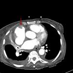 Incidental pulmonary embolus on abdominal CT, right atrial thrombus