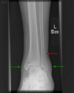 Distal fibular fracture