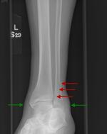 Distal fibular fracture