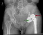 Dislocated left hip prosthesis