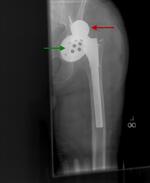 Dislocated left hip prosthesis