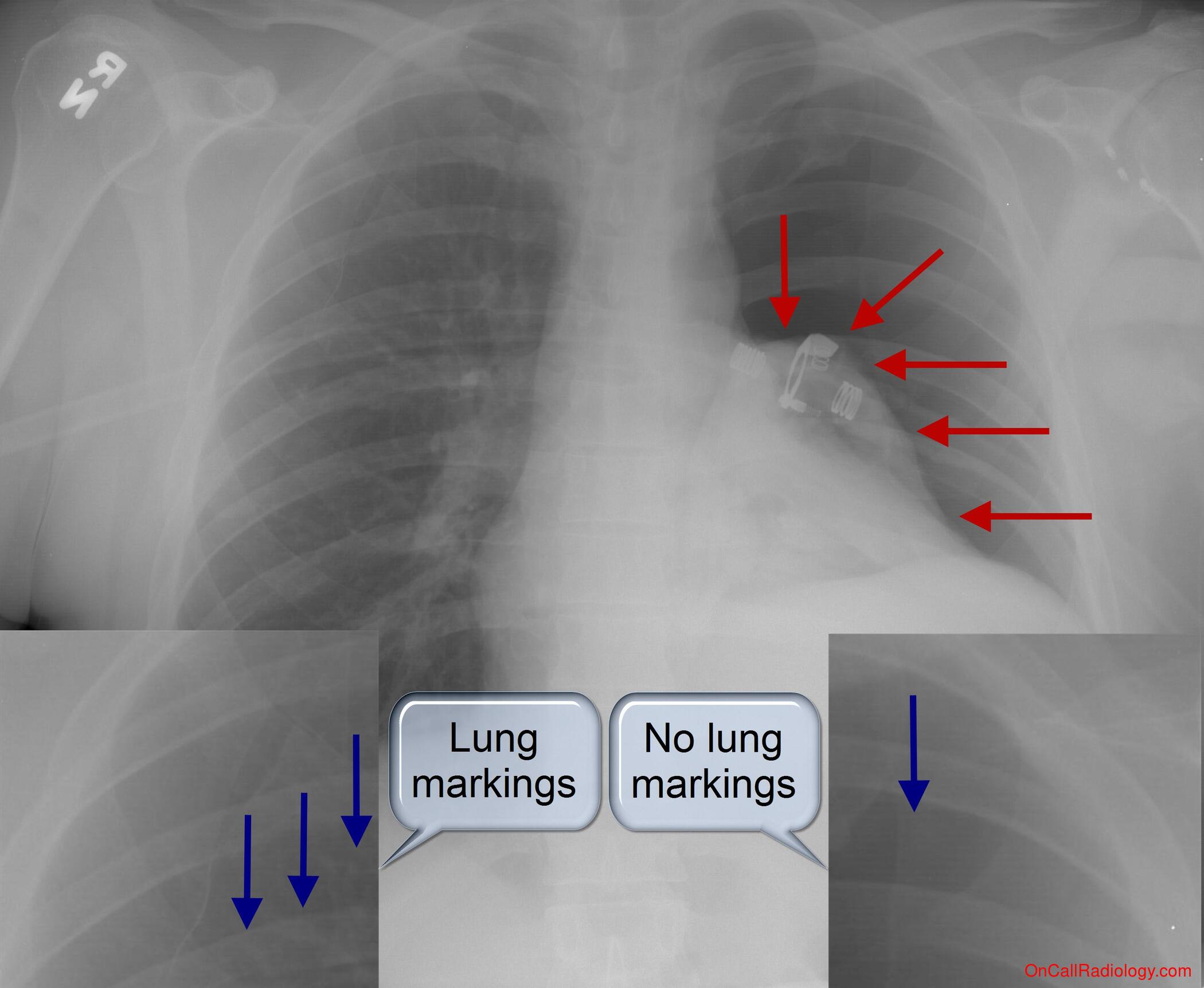 Pneumothorax (Large Pneumothorax - Plain film, Radiograph)